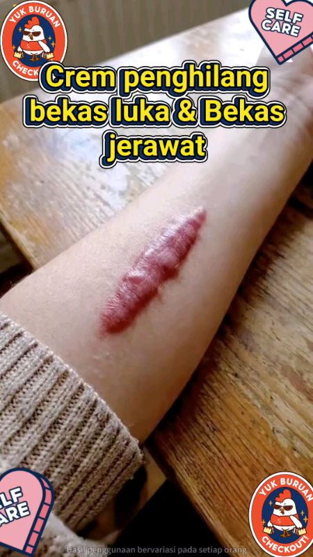 Cream penghilang bekas luka dan bekas jerawat #shopeepaylatersolusinya #creampenghilangbekasluka #spillracunshoppee #CODCekDulLu #codin