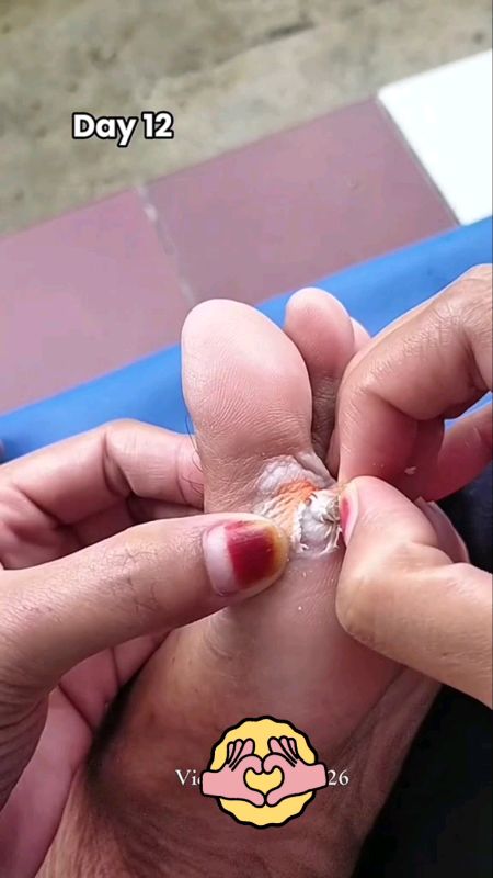 #plestermataikan #plestermataikanmurah #obatmataikan #RacunShopee #RacunShopeeCheck #SpillRacunShopee #SpillBawaBerkah #ShopeeLook #shopeevideo